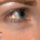 Image for article titled Woman Has Heart-Shaped Twinkle Surgically Implanted on Her Eyeball